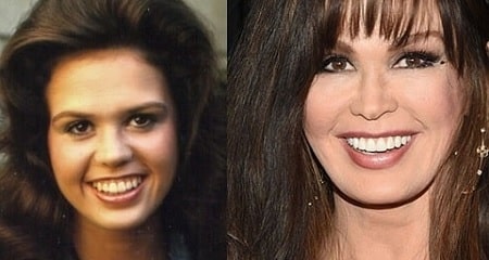 A picture of Marie Osmond before (left) and after (right).